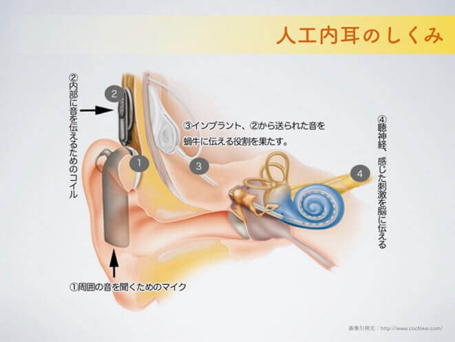人工 内耳 手術